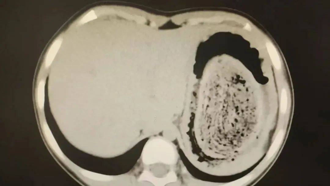 皇冠登3管理出租
_发现1例皇冠登3管理出租
，15岁女孩确诊！